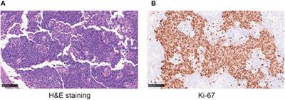 Case report: The treatment for olfactory neuroblastoma combined with leptomeningeal carcinomatosis via an ommaya reservoir